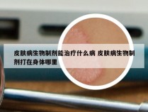 皮肤病生物制剂能治疗什么病 皮肤病生物制剂打在身体哪里