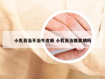 小乳膏治不治牛皮癣 小乳膏治银屑病吗