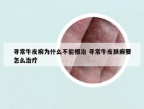 寻常牛皮癣为什么不能根治 寻常牛皮肤癣要怎么治疗