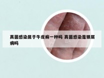 真菌感染属于牛皮癣一种吗 真菌感染是银屑病吗