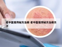 老中医祖传秘方治癣 老中医祖传秘方治癣方子