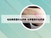 毛丝癣真菌什么药擦 毛癣菌用什么药膏