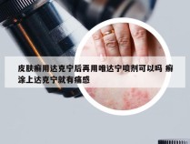 皮肤癣用达克宁后再用唯达宁喷剂可以吗 癣涂上达克宁就有痛感