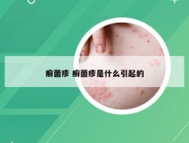 癣菌疹 癣菌疹是什么引起的