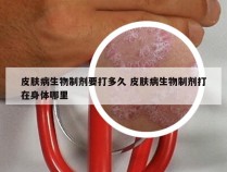 皮肤病生物制剂要打多久 皮肤病生物制剂打在身体哪里