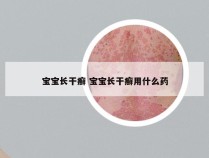 宝宝长干癣 宝宝长干癣用什么药