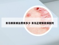 青岛银屑病治费用多少 青岛正规银屑病医院