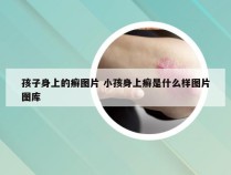 孩子身上的癣图片 小孩身上癣是什么样图片图库