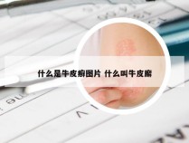 什么是牛皮癣图片 什么叫牛皮廨