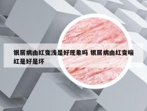 银屑病由红变浅是好现象吗 银屑病由红变暗红是好是坏