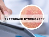 有了牛皮藓怎么治疗 有牛皮病癣怎么治疗好