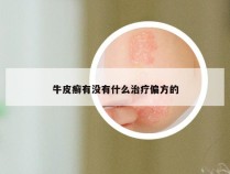 牛皮癣有没有什么治疗偏方的