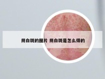 阴白斑的图片 阴白斑是怎么得的