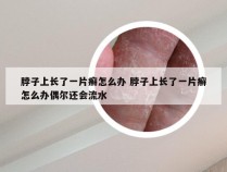 脖子上长了一片癣怎么办 脖子上长了一片癣怎么办偶尔还会流水