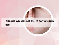 皮肤病用生物制剂效果怎么样 治疗皮肤生物制剂