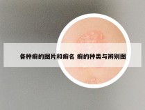 各种癣的图片和癣名 癣的种类与辨别图