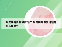 牛皮肤癣反复如何治疗 牛皮肤癣恢复过程是什么样的?