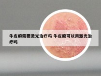 牛皮癣需要激光治疗吗 牛皮廨可以用激光治疗吗