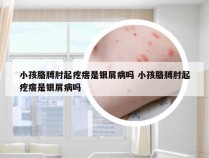 小孩胳膊肘起疙瘩是银屑病吗 小孩胳膊肘起疙瘩是银屑病吗