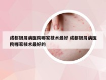 成都银屑病医院哪家技术最好 成都银屑病医院哪家技术最好的