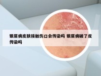 银屑病皮肤接触伤口会传染吗 银屑病破了皮传染吗