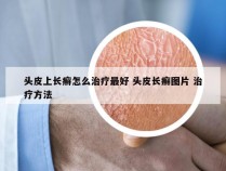 头皮上长癣怎么治疗最好 头皮长癣图片 治疗方法