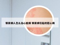 银屑病人怎么治心脏病 银屑病引起的冠心病