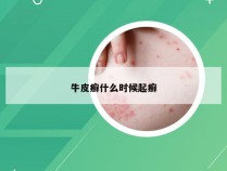 牛皮癣什么时候起癣