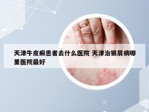 天津牛皮癣患者去什么医院 天津治银屑病哪里医院最好