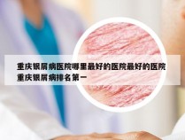 重庆银屑病医院哪里最好的医院最好的医院 重庆银屑病排名第一