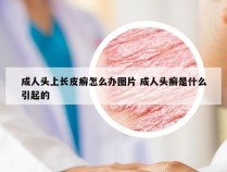 成人头上长皮癣怎么办图片 成人头癣是什么引起的