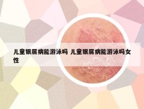 儿童银屑病能游泳吗 儿童银屑病能游泳吗女性