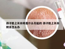 孩子脸上长白班是什么引起的 孩子脸上长白斑该怎么办