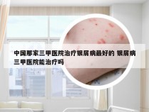 中国那家三甲医院治疗银屑病最好的 银屑病三甲医院能治疗吗