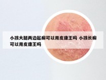 小孩大腿两边起癣可以用皮康王吗 小孩长癣可以用皮康王吗