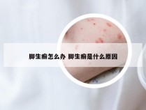 脚生癣怎么办 脚生癣是什么原因