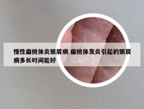 慢性扁桃体炎银屑病 扁桃体发炎引起的银屑病多长时间能好