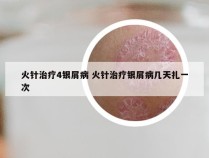 火针治疗4银屑病 火针治疗银屑病几天扎一次