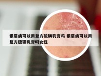 银屑病可以用复方硫磺乳膏吗 银屑病可以用复方硫磺乳膏吗女性