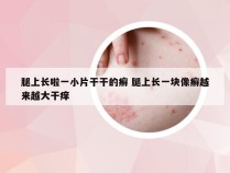 腿上长啦一小片干干的癣 腿上长一块像癣越来越大干痒