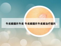 牛皮廨图片牛皮 牛皮廨图片牛皮廨治疗图片