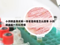 小孩膝盖像皮癣一样老是痒是怎么回事 小孩膝盖起一片红疙瘩