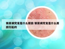 银屑病究竟是什么原因 银屑病究竟是什么原因引起的