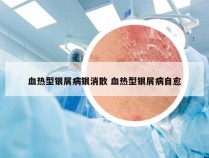 血热型银屑病银消散 血热型银屑病自愈