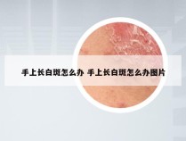 手上长白斑怎么办 手上长白斑怎么办图片