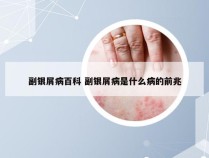 副银屑病百科 副银屑病是什么病的前兆