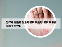 怎样中西医结合治疗银屑病最好 银屑病中西医哪个疗效好