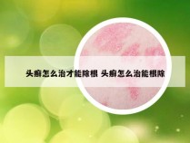 头癣怎么治才能除根 头癣怎么治能根除