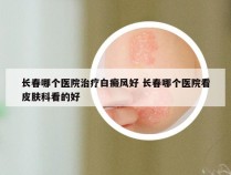 长春哪个医院治疗白癜风好 长春哪个医院看皮肤科看的好