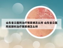 山东省立医院治疗银屑病怎么样 山东省立医院皮肤科治疗银屑病怎么样